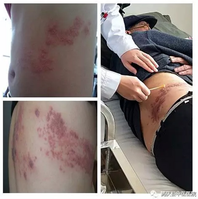 鹤庆县中医医院内科火针治疗带状疱疹疗效好(图1)