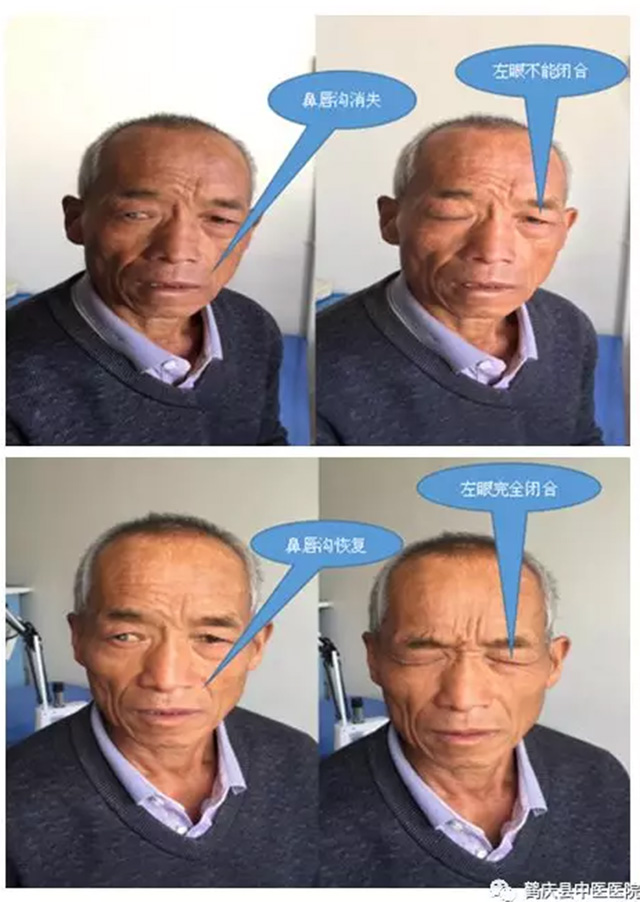 鹤庆县中医院针灸科针灸、中药综合治疗面瘫病疗效满意(图7)